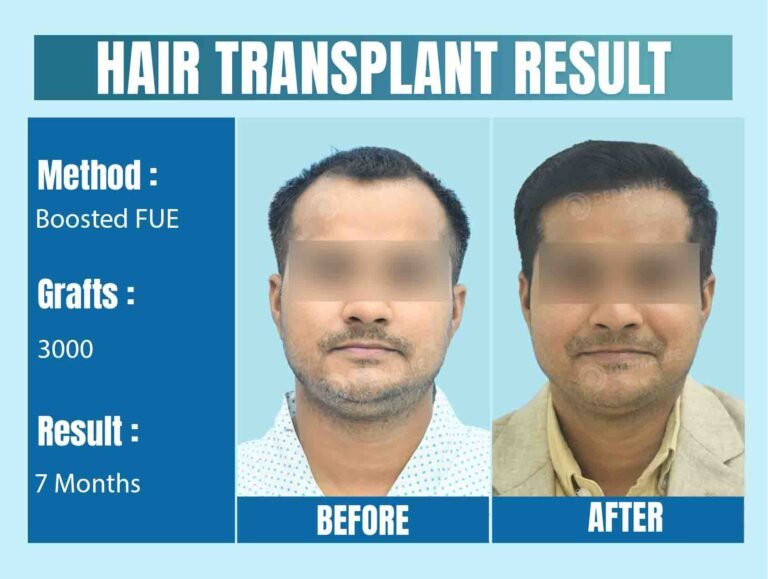 How to Choose a Qualified Hair Transplant Surgeon in Delhi?